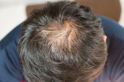 Hair Transplant To Fight Thinning Hair Hair T