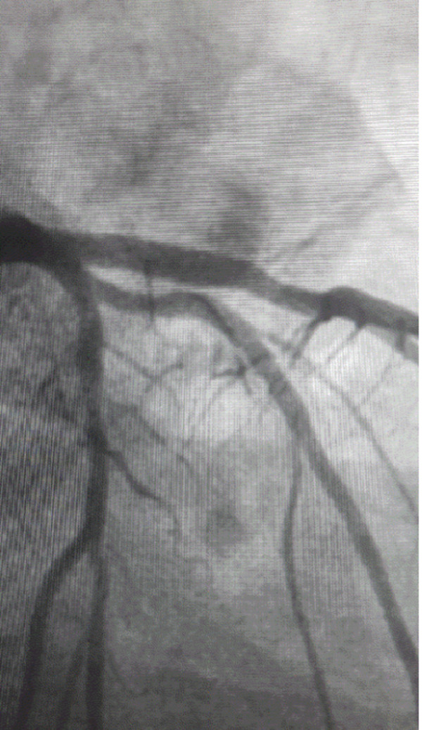 Stent-ectasia : Is stent oversizing good or bad ? | Interventional Cardiology | Scoop.it