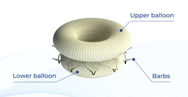 TCT 2024: Adjustable valve replacement system wins Shark Tank innovation prize | Transcatheter Treatment of Mitral Regurgitation | Scoop.it
