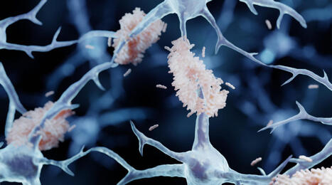 La ventana de oportunidad frente al Alzheimer: "Si se retrasa el tratamiento, hay riesgo de que el paciente avance a demencia moderada" | Alzheimer y m&aacute;s (Bolet&iacute;n n&ordm; 95) | Scoop.it