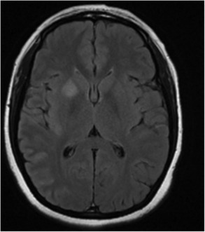 A Pounding Problem: A Case of Recurrent Headache Caused by Anti-NMDA Receptor Encephalitis | AntiNMDA | Scoop.it