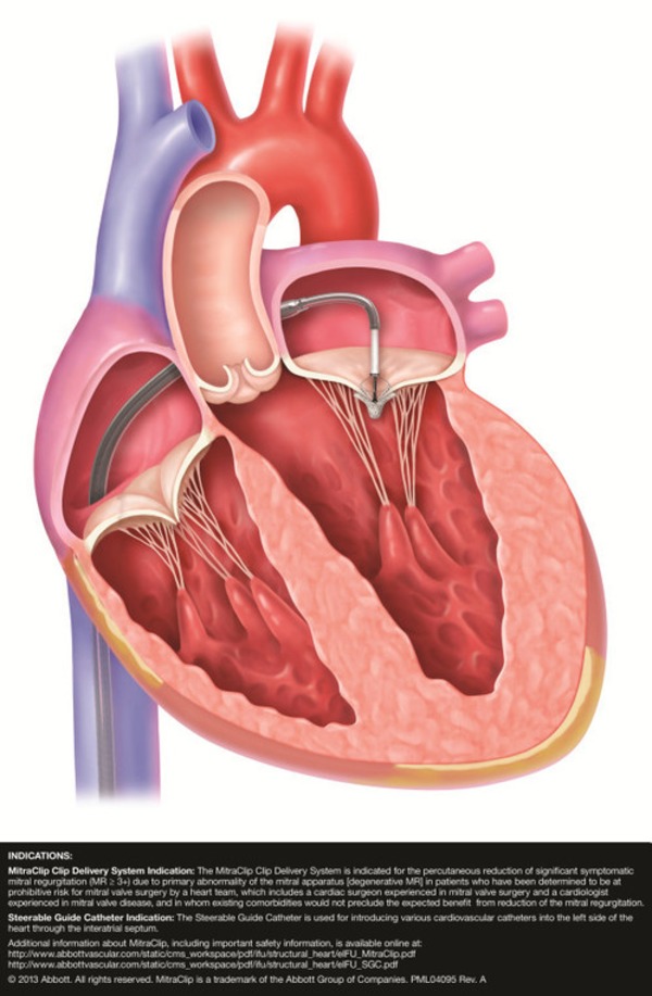 FDA device approval: Abbott gets a nod for less invasive mitral valve repair ... - MedCity News | Transcatheter Treatment of Mitral Regurgitation | Scoop.it