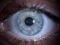Lentes de contacto para los ojos secos | Salud Visual 2.0 | Scoop.it