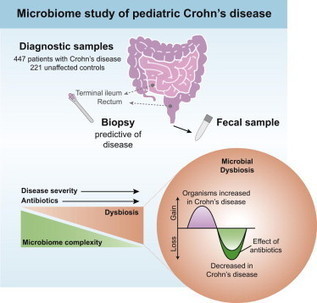 The Treatment-Naive Microbiome in New-Onset Crohn’s Disease | Immunopathology & Immunotherapy | Scoop.it