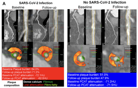 SARS-CoV-2 Infection Association with Atherosclerotic Plaque Progression and Adverse Cardiovascular Events | Virus World | Scoop.it