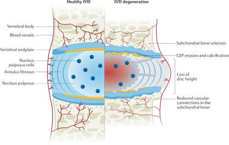 Mechanisms and clinical implications of intervertebral disc calcification | Nature Reviews Rheumatology | Rheumatology-Rhumatologie | Scoop.it