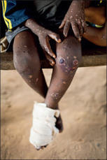 Monkeypox contacts: a puzzling problem | Virology News | Scoop.it