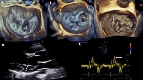 Asymptomatic severe degenerative mitral regurgitation | Transcatheter Treatment of Mitral Regurgitation | Scoop.it