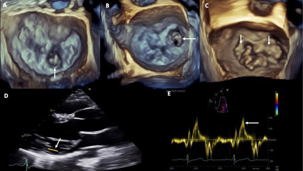 Asymptomatic severe degenerative mitral regurgitation | Transcatheter Treatment of Mitral Regurgitation | Scoop.it
