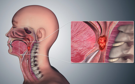 New Test for Early Detection of HPV-Associated Oropharyngeal Cancer | Virus World | Scoop.it