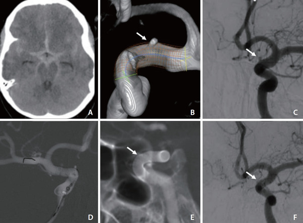 Early Flow-Diverter Implantation in Ruptured Intracranial Aneurysms: Safety and Outcomes in a Resource-Limited Setting | Neurovascular Intervention | Scoop.it