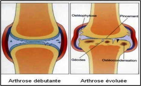 Arthrose : Définition | L'arthrose | Scoop.it