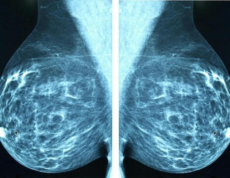 New switchable CAR-T therapy enters phase 1 trial for advanced breast cancer | Genetic Engineering Publications - GEG Tech top picks | Scoop.it