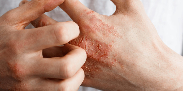 Association between atopic dermatitis and risk of stroke: a systematic review and meta-analysis | Neurovascular Intervention | Scoop.it