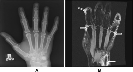 Cowden's Syndrome, Bannayan-Riley-Ruvalcaba Syndrome, PTEN Hamartoma ...