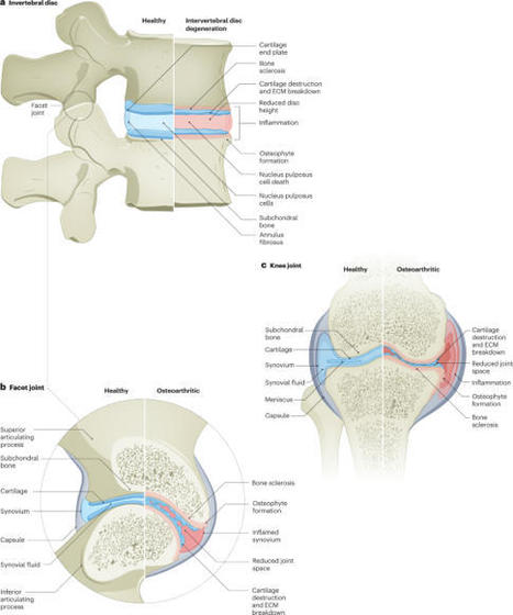 Intervertebral disc degeneration and osteoarthritis: a common molecular disease spectrum | Nature Reviews Rheumatology | Rheumatology-Rhumatologie | Scoop.it
