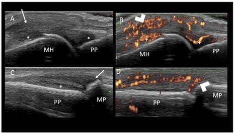 JCM | Free Full-Text | Accuracy of Physical Examination to Detect Synovial and Extra-Synovial Pathologies in Psoriatic Arthritis in Comparison to Ultrasonography | Rheumatology-Rhumatologie | Scoop.it