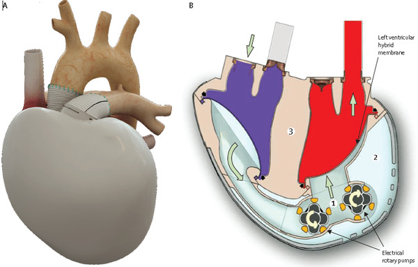 CARMAT - Artificial Heart | Interventional Cardiology | Scoop.it