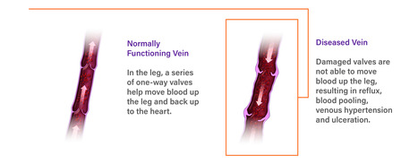 enVVeno Medical Receives FDA IDE Approval for Non-Surgical Replacement Venous Valve | Critical Limb-Threatening Ischemia (CLTI) | Scoop.it