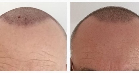 Best Post Surgery Guidance Hair Transplant Clin