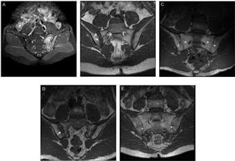 Frontiers | Active Inflammatory and Chronic Structural Damages of Sacroiliac Joint in Patients With Radiographic Axial Spondyloarthritis and Non-Radiographic Axial Spondyloarthritis | Immunology | Rheumatology-Rhumatologie | Scoop.it