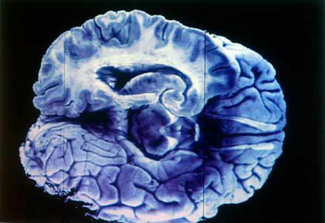 Alzheimer, enfermedad generada por hasta 20 años de daños en el cerebro | Alzheimer y más (Boletín nº 71) | Scoop.it