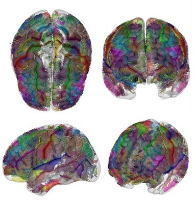 Troubles du spectre de l&rsquo;autisme : une &eacute;tude d&rsquo;imagerie c&eacute;r&eacute;brale in&eacute;dite remet en cause le mod&egrave;le th&eacute;orique dominant | Life Sciences Universit&eacute; Paris-Saclay | Scoop.it