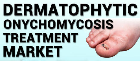 Dermatophytic Onychomycosis Treatment Market Size | Trends[2027] | Healthcare | Scoop.it