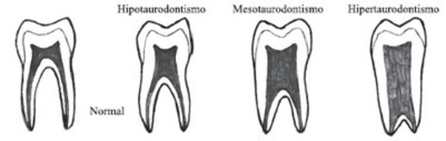 Resultado de imagen para taurodontismo