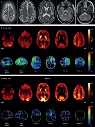 Nmdar encephalitis outlet