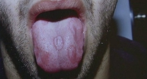 Le retour en force de la syphilis | sida | Scoop.it