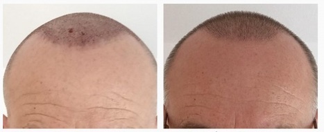 Hair Transplant Scoop It