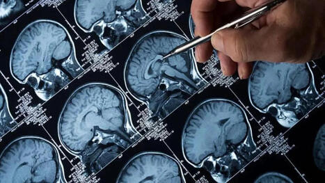 Mumbai doctors observing rise in brain stroke cases during the winter | Neurovascular Intervention | Scoop.it