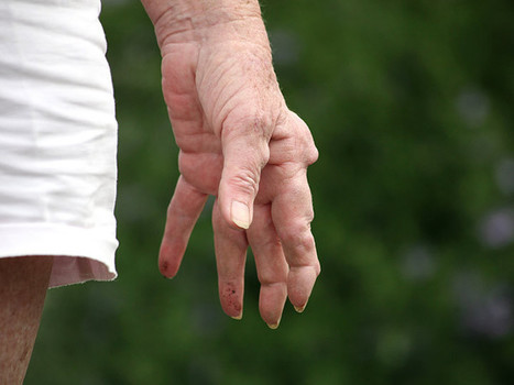 BrCa Risk Stable With Anti-TNF Tx - MedPage Today | Rheumatology-Rhumatologie | Scoop.it