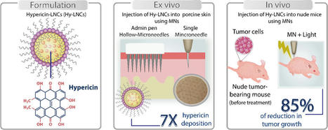 Hollow microneedle assisted intradermal delivery of hypericin lipid nanocapsules with light enabled photodynamic therapy against skin cancer | Intra-Dermal drug delivery: Opportunities and Challenges? | Scoop.it