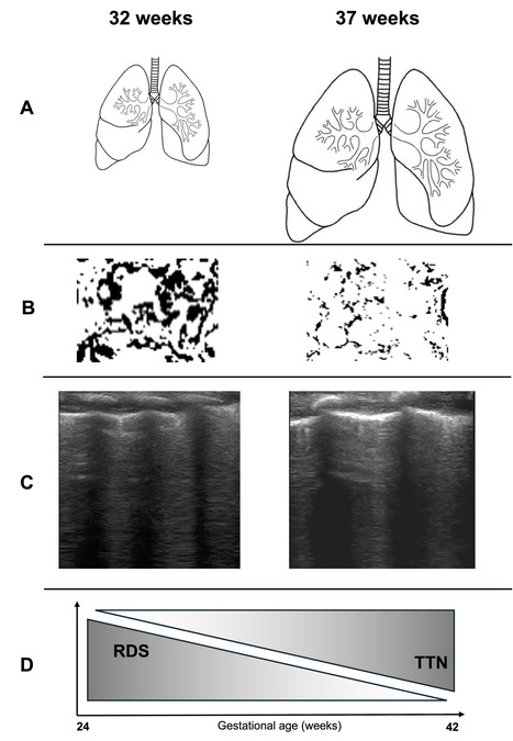 Des nouveautés sur la tachypnée transitoire, la maladie respiratoire commune du nouveau-né | Life Sciences Université Paris-Saclay | Scoop.it