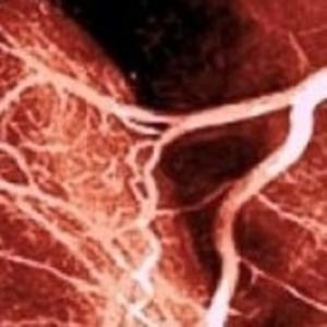 Replacement Versus Repair for Mitral Valve Regurgitation | Transcatheter Treatment of Mitral Regurgitation | Scoop.it