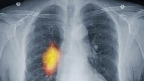 Early cancer diagnosis variation 'unacceptable' | Public Health - Santé Publique | Scoop.it