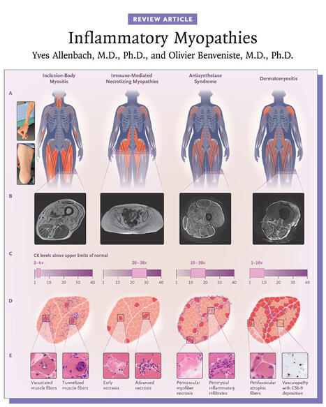 Inflammatory Myopathies and Autoantibodies Impact Diagnosis and Prognosis | NEJM Group posted on the topic | AUTOIMMUNITY | Scoop.it
