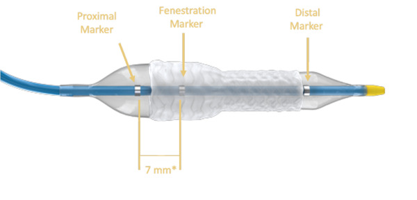 World’s first dedicated FEVAR bridging stent heralds ‘simple, swift and stable’ procedures for all endovascular specialists | Interventional Cardiology | Scoop.it