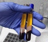 J'ai testé les injections de PRP Plasma Riche en Plaquettes - Martine et le slow aging | Chirurgie esthétique - médecine esthétique - digital | Scoop.it