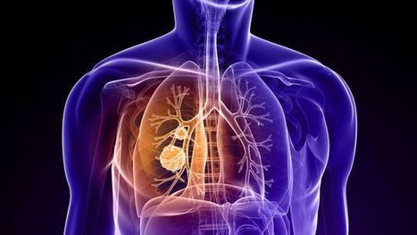 #msante Une appli contre le #cancer du #poumon #hcsmeufr  | M-HEALTH  By PHARMAGEEK | Scoop.it