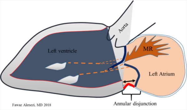 Mitral Annular Disjunction: Review of an Increasingly Recognized Mitral Valve Entity | Transcatheter Treatment of Mitral Regurgitation | Scoop.it