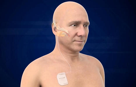 Première publication sur un nouveau dispositif complètement implantable | Revue de presse Implant Cochléaire | Scoop.it