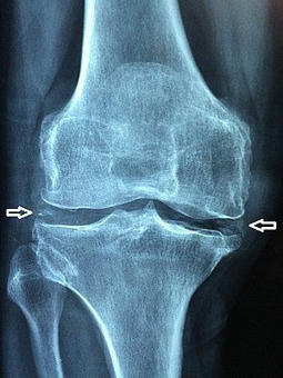 Pseudogout, chondrocalcinosis, CPPD et al: crystal clear… or clear as… | Frédéric Lioté | Rheumatology-Rhumatologie | Scoop.it