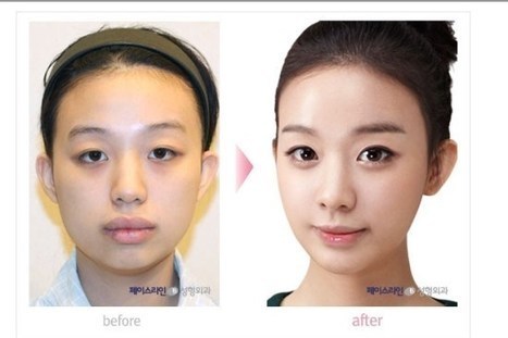 Avant/apr&egrave;s : la chirurgie des m&acirc;choires en Cor&eacute;e du Sud | Trollface , meme et humour 2.0 | Scoop.it