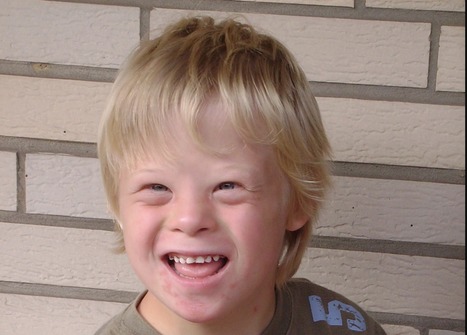 Down Syndrome Associated with 10-fold Increased Risk for COVID-19 Mortality | Virus World | Scoop.it