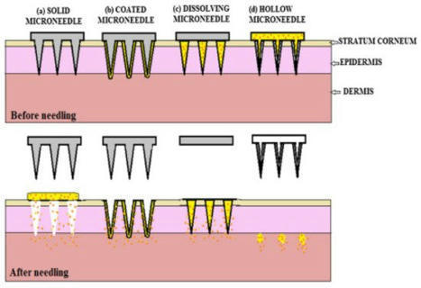 Recent Advancements in Microneedle Technology for Multifaceted Biomedical Applications | Intra-Dermal drug delivery: Opportunities and Challenges? | Scoop.it