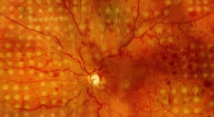 Diabetes y Visión | IMO Instituto de Microcirugía Ocular – Oftalmología en Barcelona | Formación Optometristas 2.0 | Scoop.it
