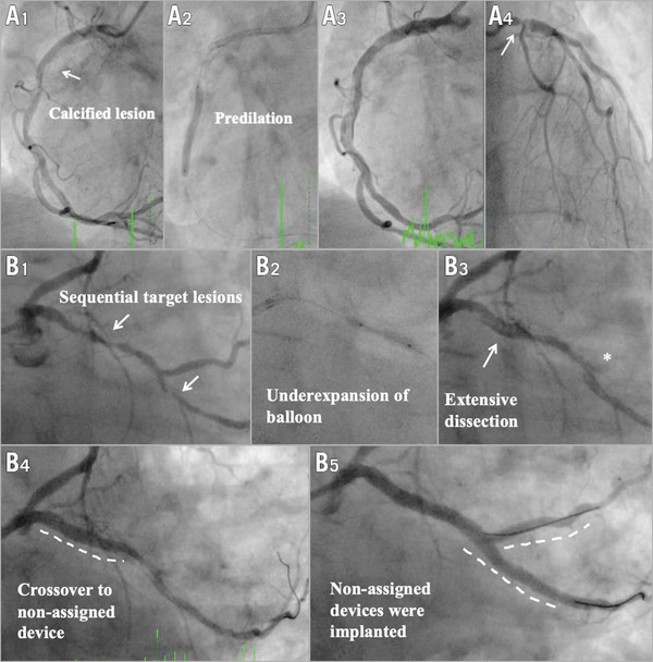 Defining device success for percutaneous coronary intervention trials: a position statement from the European Association of Percutaneous Cardiovascular Interventions&nbsp; | Interventional Cardiology | Scoop.it